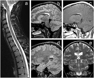 Progressive Tumefactive Demyelination as the Only Result of Extensive Diagnostic Work-Up: A Case Report